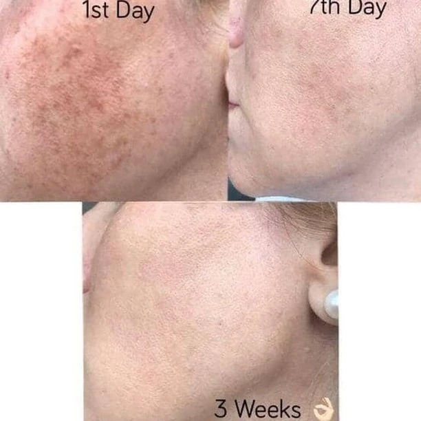 OPT SHR Hair Removal Machine best